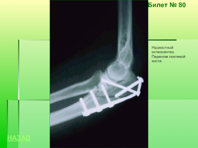 Перелом локтевой кости фото. Остеосинтез переломов локтевой кости. Перелом локтевого остеосинтез. Остеосинтез локтевого отростка пластиной. Остеосинтез перелома локтевого отростка по Веберу.
