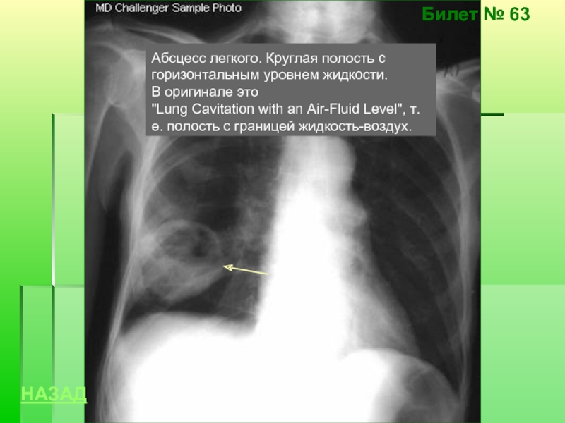 Горизонтальные уровни жидкости. Рентген при абсцессе легкого. Горизонтальный уровень жидкости на рентгенограмме. Абсцесс в легком рентген. Уровень жидкости в легких на рентгене.