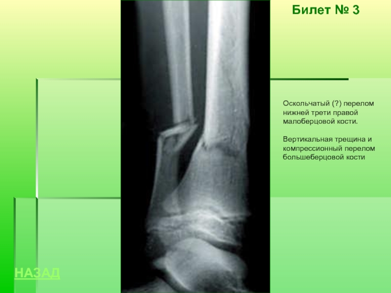 Перелом трети голени. Рентген перелома нижней трети малоберцовой кости. Оскольчатый перелом малоберцовой кости рентген. Перелом нижней трети большеберцовой кости рентген. Оскольчатый перелом большеберцовой кость.