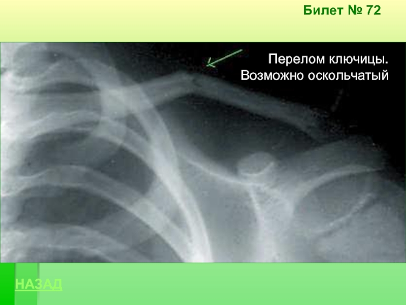 Что делать если сломал ключицу. Поднадкостничный перелом ключицы. Поднадкостничный перелом ключицы рентген. Перелом ключицы рентген. Поднадкостничный перелом ключицы у детей.