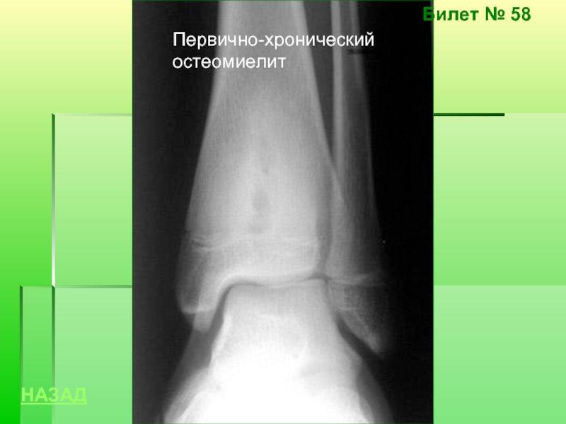 Хронический остеомиелит. Первично хронический остеомиелит. Первично хронический гематогенный остеомиелит. Формы первично-хронического остеомиелита. Первичный и вторичный остеомиелит.