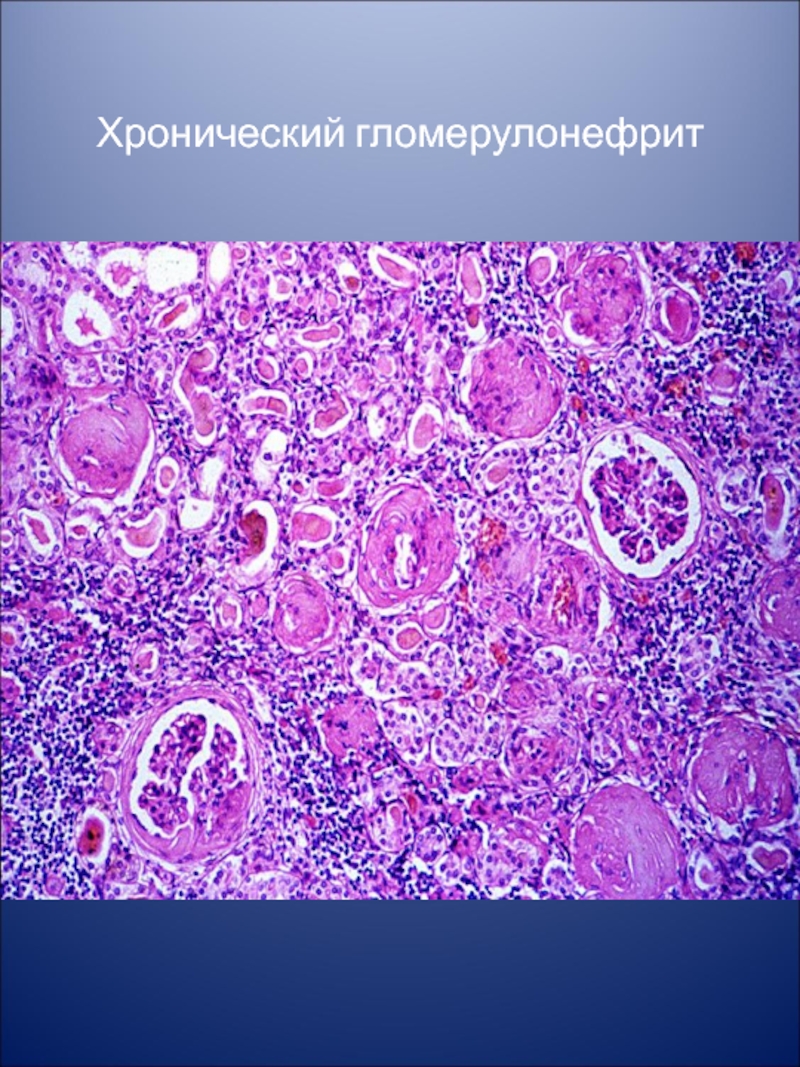 Острый гломерулонефрит микроскопическая картина