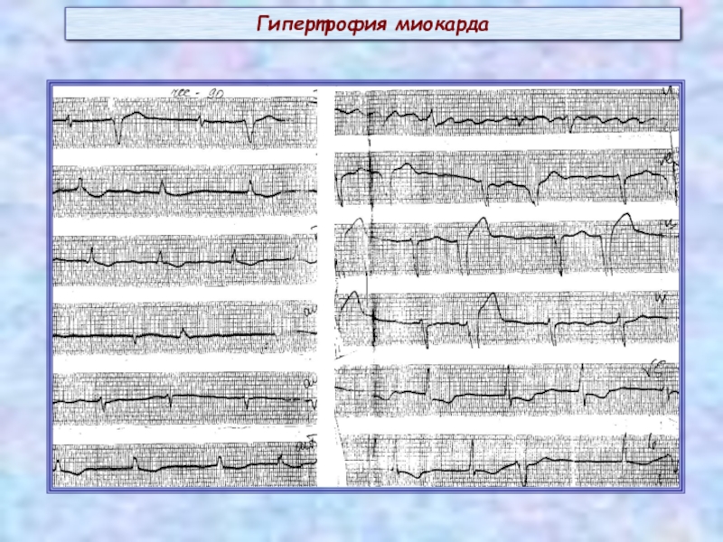 Диагностика гипертрофии. Виды гипертрофии миокарда.