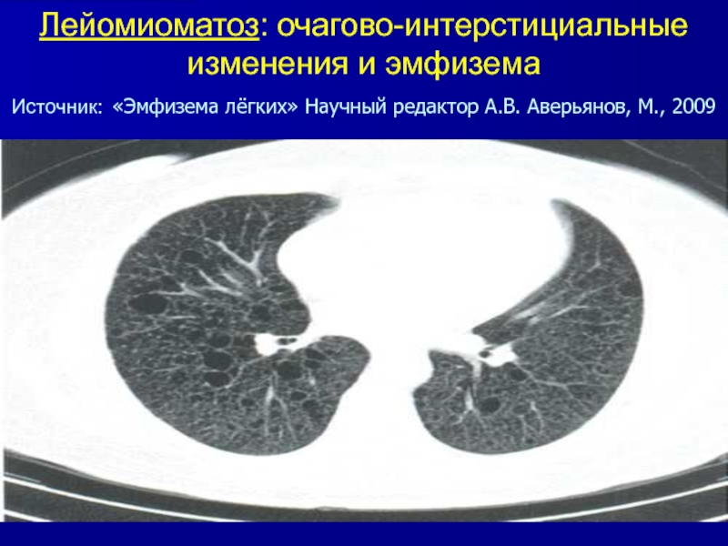 Картина интерстициальных изменений в легких кт что это