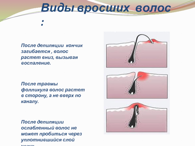 Вросшие волосы после депиляции. Классификация вросших волос. Профилактика вросших волос.