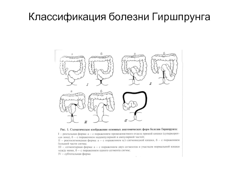 Клиническая картина ректальной формы болезни гиршпрунга характеризуется