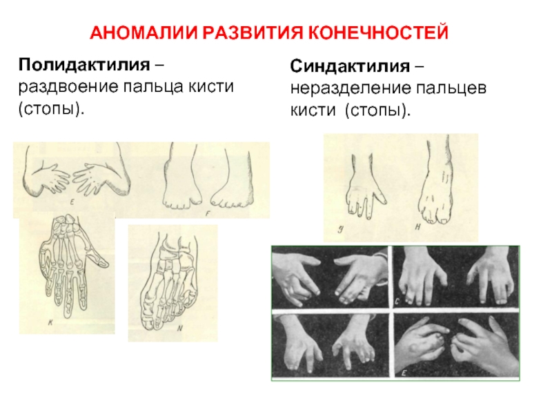 Аномалии развития. Врожденные пороки развития кисти. Синдактилия эмбриогенез. Аномалии развития пальцев. Аномалии развития фаланг пальцев кисти.