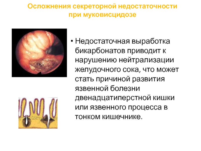 Курсовая работа: Заместительная терапия при муковисцидозе