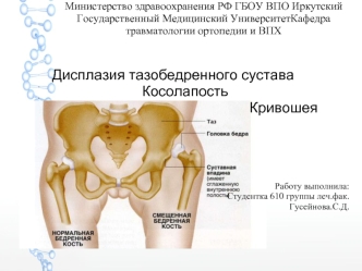 Дисплазия тазобедренного сустава. Косолапость. Кривошея