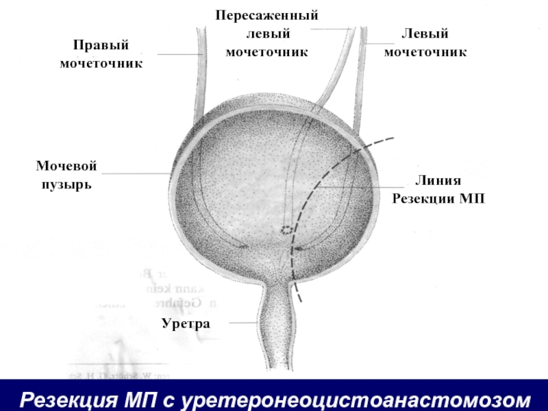 Схема мужского мочеиспускательного канала