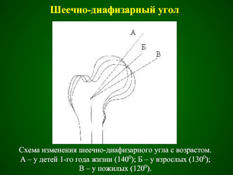 Бедренный угол. Норма шеечно-диафизарного угла. Шеечно-диафизарный угол норма. Шеечно-диафизарный угол измерение. Шеечно-эпифизарный угол.