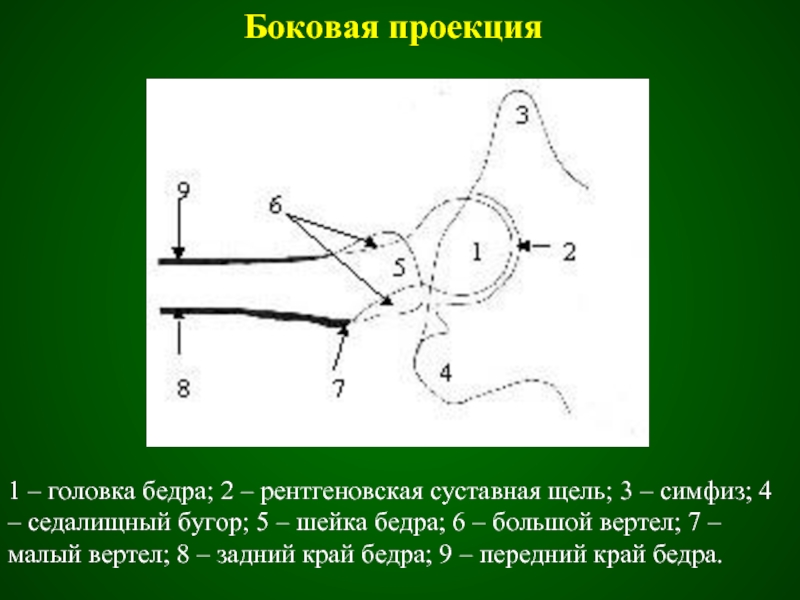 Латеральная проекция. Проекция малого вертела. Рентгеновская суставная щель. Проекция головки бедра. Проекция суставной щели.