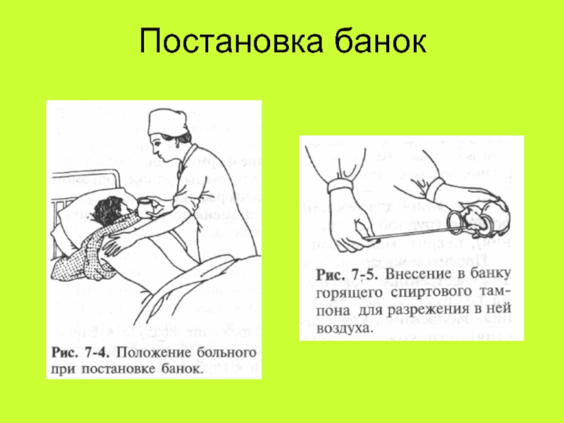 Места постановки банок схема