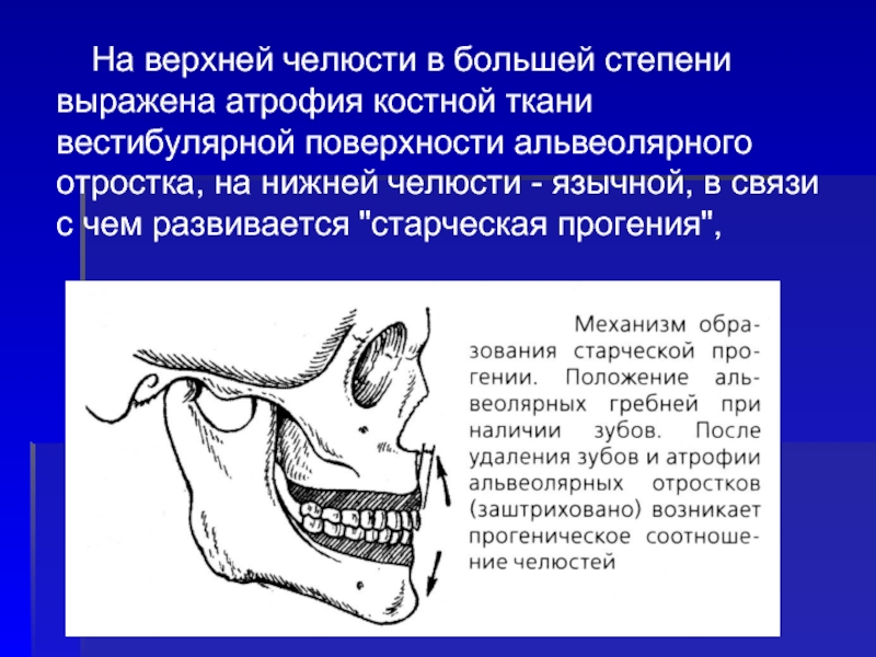 Резекция верхней челюсти презентация