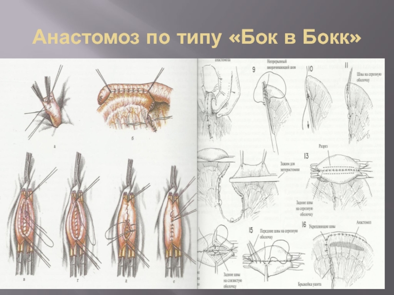 Анастомоз конец в конец схема