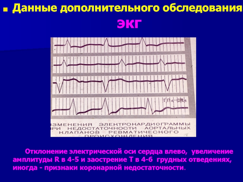 Экг отклонение влево у взрослого что это. Аортальная недостаточность ЭКГ. Порок сердца на ЭКГ. Кардиограмма с отклонениями. Отклонение оси на ЭКГ.