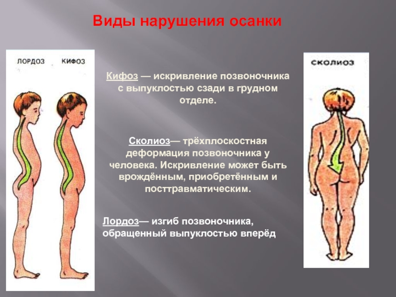 Картинки причины нарушения осанки