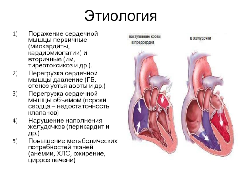 стеноз устья аорты