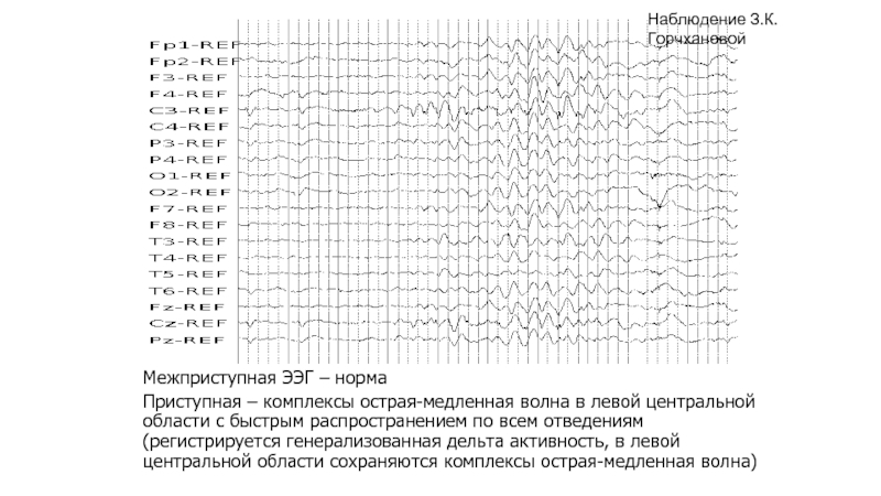 Медленные волны на ээг. ЭЭГ эпилепсия острая медленная волна. Комплекс острая волна медленная волна на ЭЭГ. Пик полипик волна на ЭЭГ. Генерализованные комплексы пик волна на ЭЭГ.