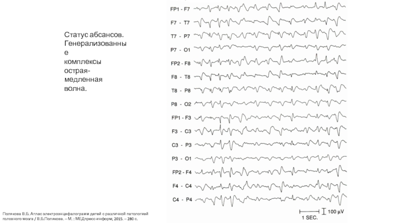 Комплекс медленных волн ээг. Комплекс острая медленная волна на ЭЭГ. Острая волна медленная волна на ЭЭГ. ЭЭГ эпилепсия пик-волна. Типичный абсанс на ЭЭГ У ребенка.