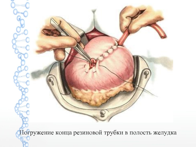 Гастростомия по витцелю