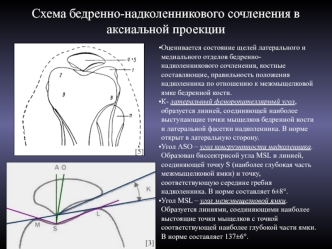 Схема бедренно-надколенникового сочленения в аксиальной проекции