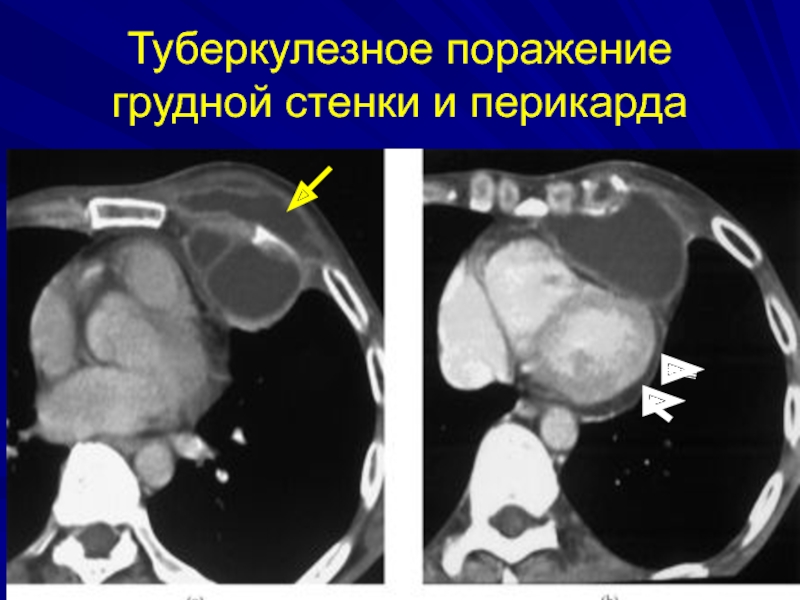 Туберкулезное поражение легких. Образование перикарда на кт. Туберкулезное поражение. Образование грудной стенки кт.