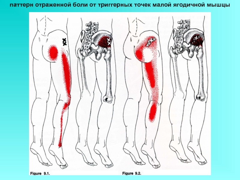 Карта триггерных точек с отраженными болями