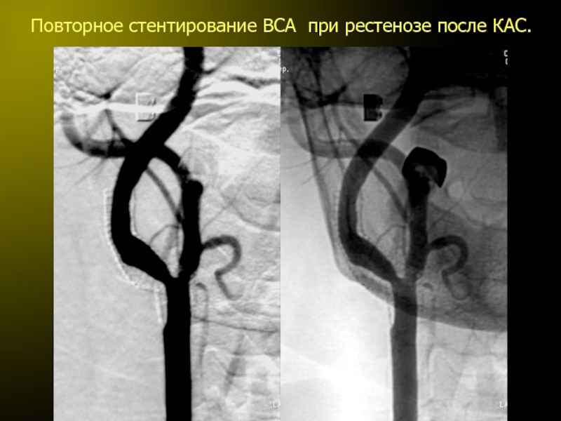 Жизнь после стентирования. Стентирование внутренней сонной артерии. Стентирование пищевода на кт. Диагноз после стентирования.