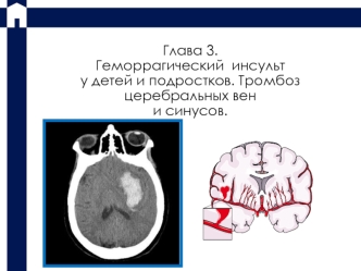 Геморрагический инсульт у детей и подростков. Тромбоз церебральных вен и синусов