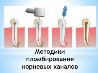 Методики пломбирования корневых каналов