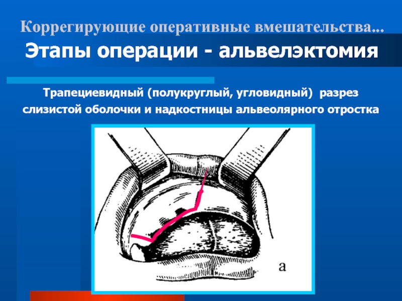 Этапы операции. Слизисто надкостничный лоскут. Этапы оперативного вмешательства. Трапециевидный разрез слизистой. Этапы оперативный хирургии.