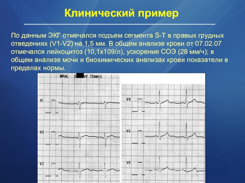 По данным ЭКГ отмечался подъем сегмента S-Т в правых грудных отведениях (V1-V2) на 1,5 мм. В общем