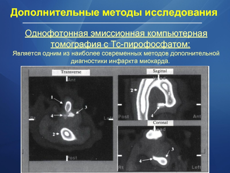 Однофотонная эмиссионная компьютерная томография с Tc-пирофосфатом: Является одним из наиболее современных методов дополнительной диагностики инфаркта миокарда. Дополнительные