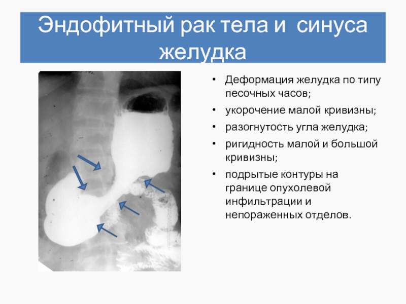 Рентгенологическая картина рака пищевода экзофитный эндофитный