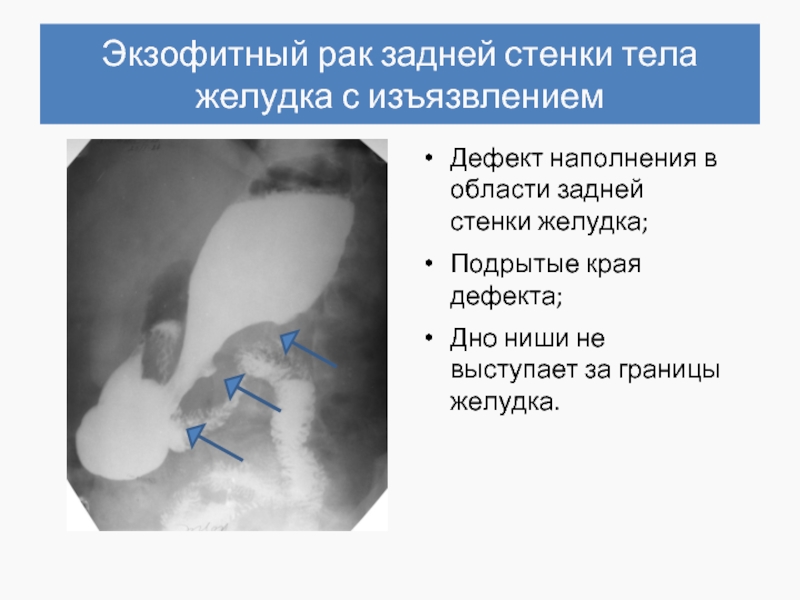 Экзофитный рак. Краевой дефект наполнения желудка рентген. Дефект наполнения в области малой кривизны желудка. Дефект наполнения при рентгенографии желудка.