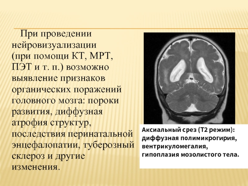Поражение мозга последствия. Туберозный склероз (эпилойя). Ангиофиброма туберозный склероз. Туберозный склероз головного мозга мрт. Туберозный склероз головного мозга кт.