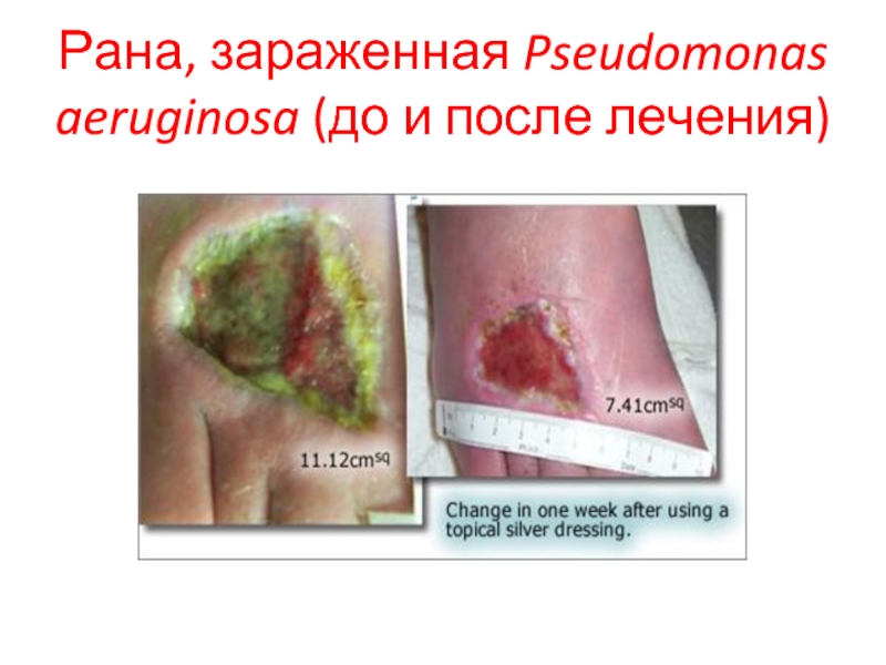 Рана, зараженная Pseudomonas aeruginosa (до и после лечения)