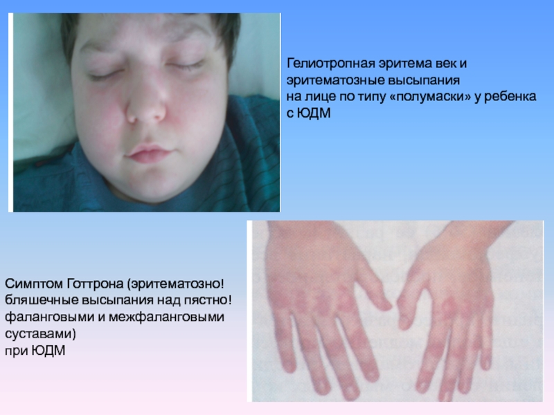 Гелиотропная эритема век и эритематозные высыпания на лице по типу «полумаски» у ребенка с ЮДМ Симптом Готтрона
