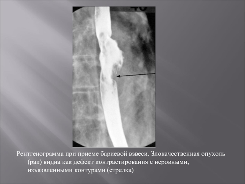 Рентгенологическая картина рака пищевода экзофитный эндофитный