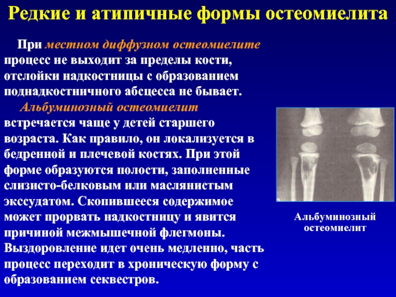 Редкие и атипичные формы остеомиелита  Альбуминозный остеомиелит