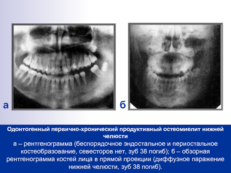 Реферат: Стоматология (Остеомиелит челюстей)