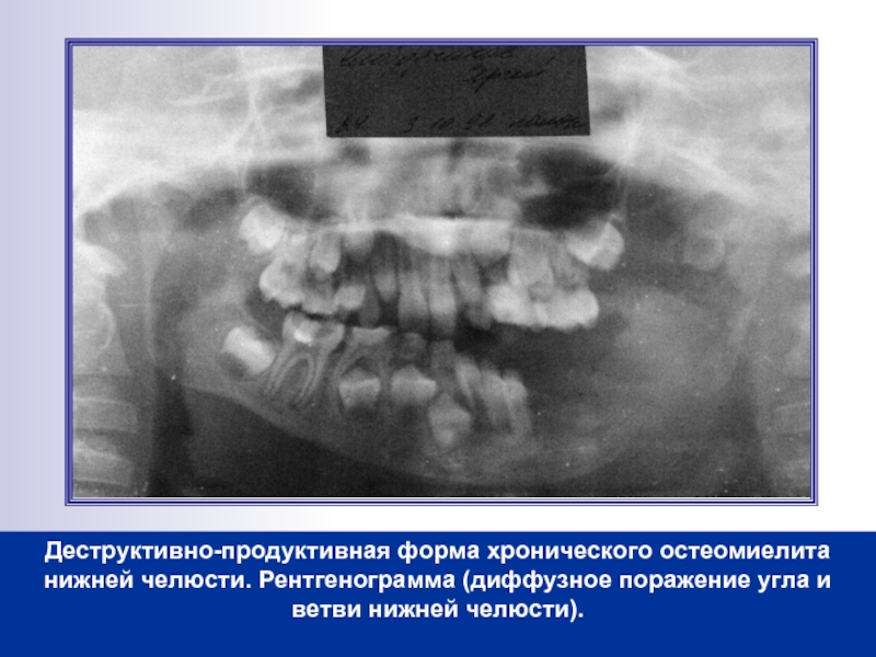 Реферат: Стоматология (Остеомиелит челюстей)