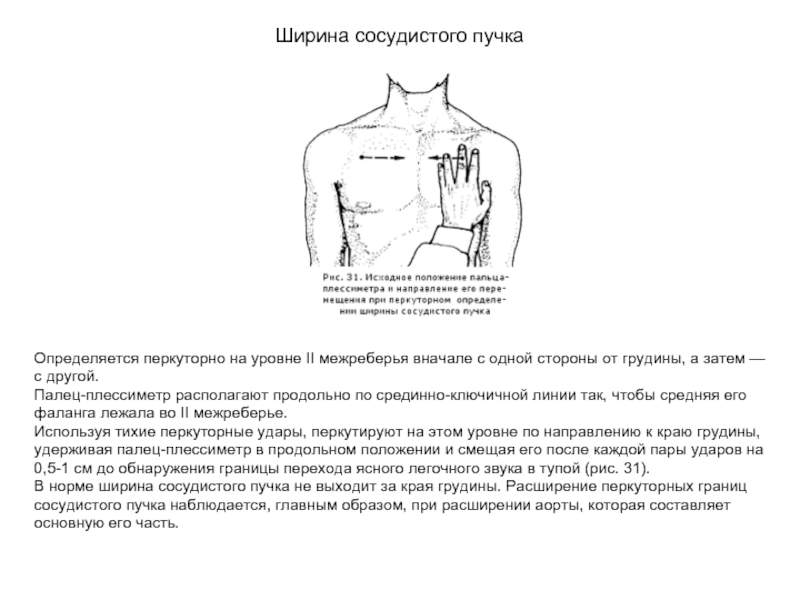 Сосудистый пучок. Определение сосудистого пучка. Ширина сосудистого пучка во 2-м межреберье. Измерение ширины сосудистого пучка. Границы сосудистого пучка перкуссия.