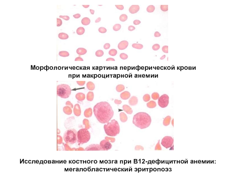 Картина крови при в12 дефицитной анемии периферической