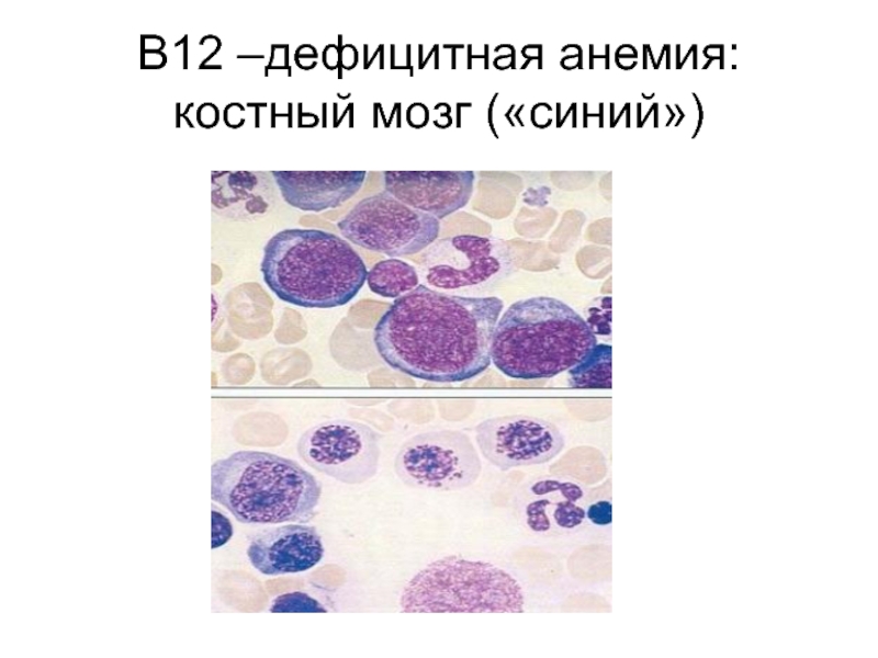 Дефицитная анемия. В12 дефицитная анемия микропрепарат. Костный мозг при в12 дефицитной анемии. В12 дефицитная анемия панцитопения. Миелограмма костного мозга в12 дефицитная анемия.