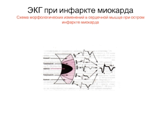 ЭКГ при инфаркте миокарда. Схема морфологических изменений в сердечной мышце при остром инфаркте миокарда