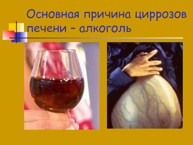 Основная причина циррозов печени – алкоголь