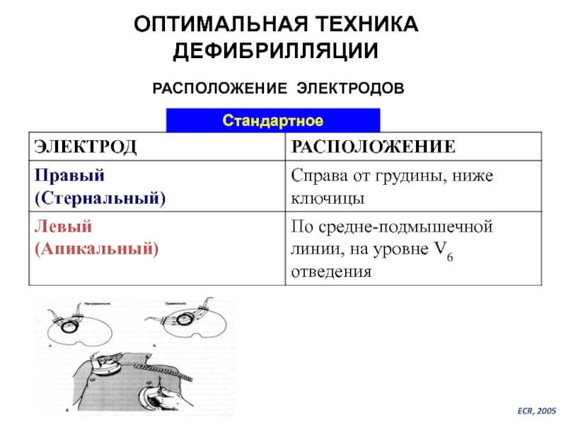 Оптимальная техника. Техника дефибрилляции.