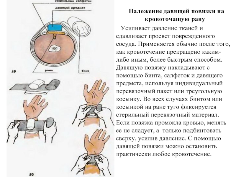 Наложение давящей повязки картинки